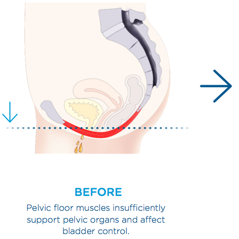 info graphic of pelvic floor strengthening