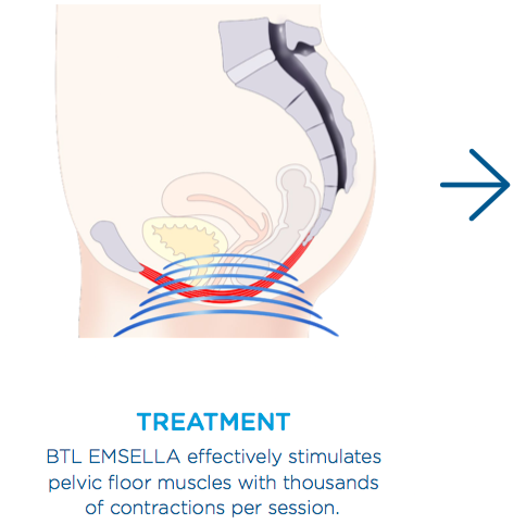 info graphic of pelvic floor strengthening