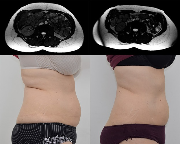 MRI and body shots of a female pre and post HIFEM treatment showing improvement