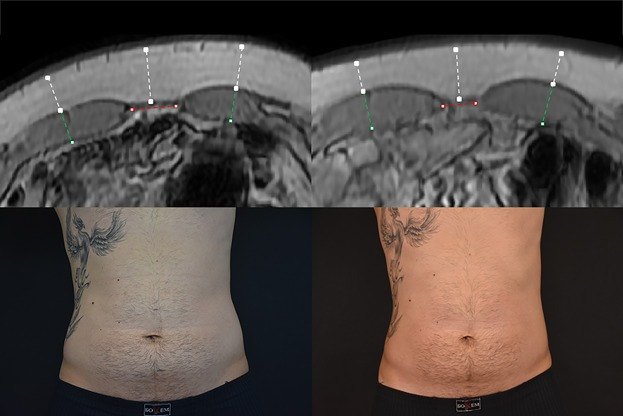 MRI and body shots of a male pre and post HIFEM treatment 