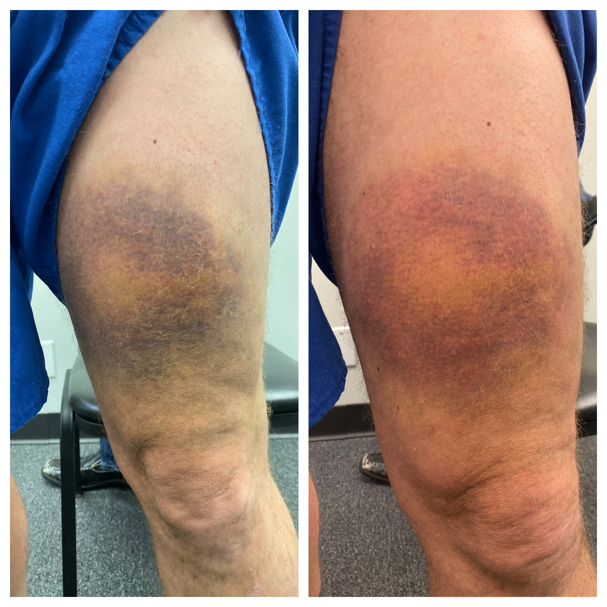 Before and after bruise improvement of the thigh after 1 unit of laser therapy