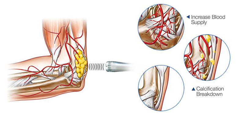 Infographic showing how shockwave therapy increases blood supply and breaks down calcification