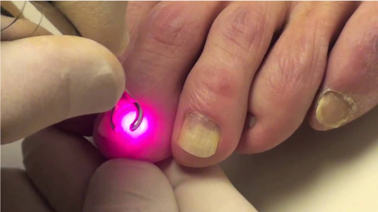 A red laser reflecting off of discolored toenails